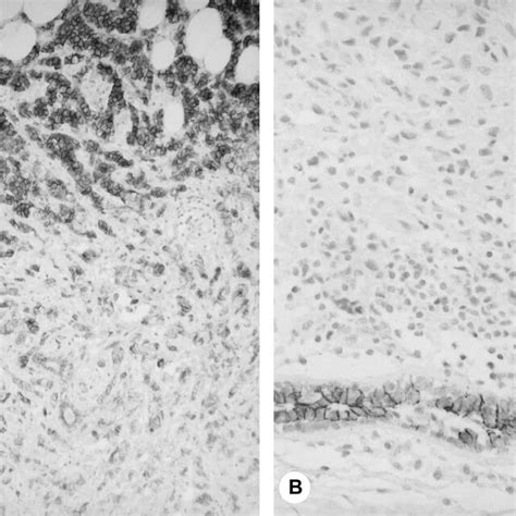 Immunohistochemical Detection Of E Cadherin Expression A B In A Case