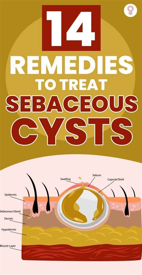 14 Home Remedies To Treat Sebaceous Cysts Artofit