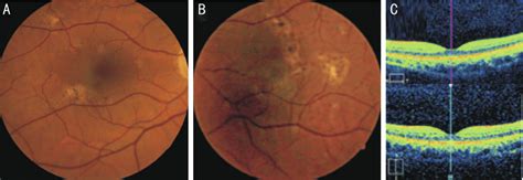 Fundus Photo Of The Right A And Left Eye B Showed Numerous Scars