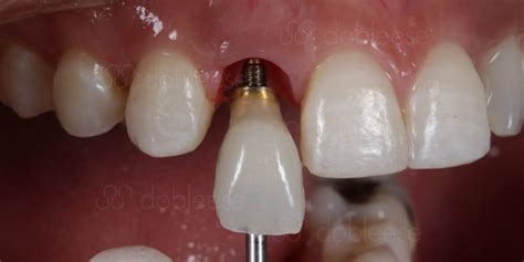 Fantástico Adivinar Disparates implantes dentales atornillados