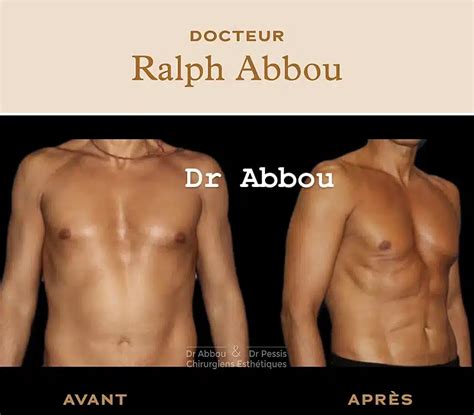 Liposuccion Du Ventre Paris Dr Abbou Et Dr Pessis