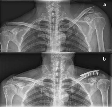 a Pre-operative radiograph shows a displaced distal clavicle ...