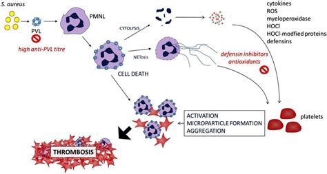 Simplified Summary Pvl Expressed By S Aureus Induces Neutrophil