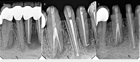 Periapical Radiographs Pas Of The Right Mandibular Canine