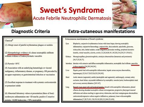 Sweet S Syndrome Acute Febrile Neutrophilic Dermatosis