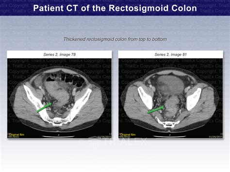 Patient Ct Of Rectosigmoid Colon Trialquest Inc