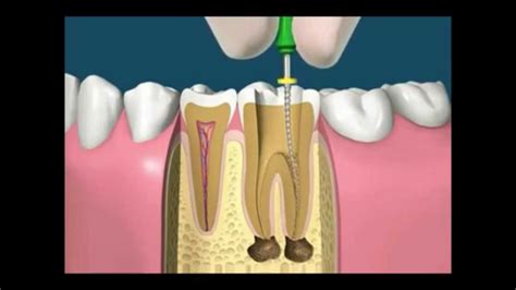 Endodontia Tratamento De Canal Dentário Ortomix Odontologia