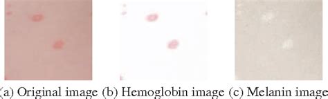 Figure 2 From Erythema Detection In Digital Skin Images Semantic Scholar