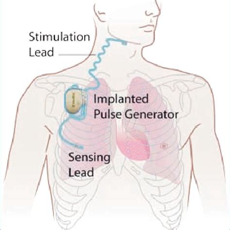 Pdf The Uas Therapy Of Inspire™ Upper Airway Stimulation Upper