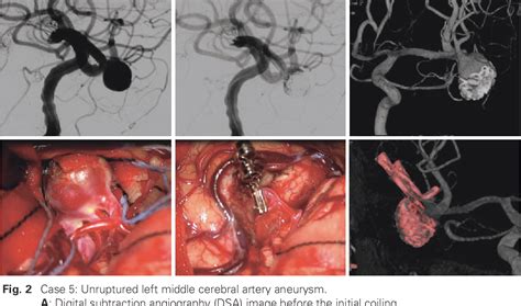 Figure From Microsurgical Clipping For Previously Coiled Intracranial