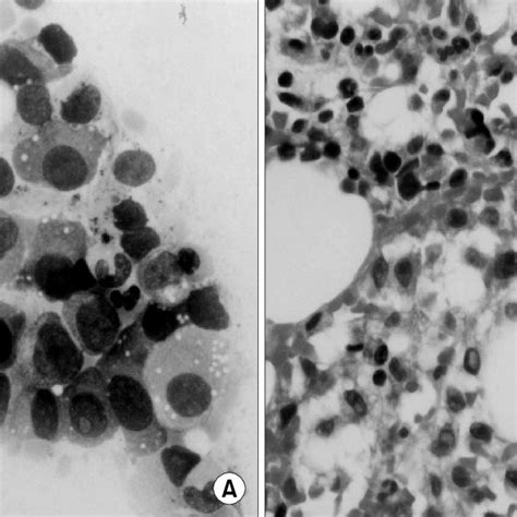 Bone Marrow Aspiration And Biopsy A Aspiration Smear Showing