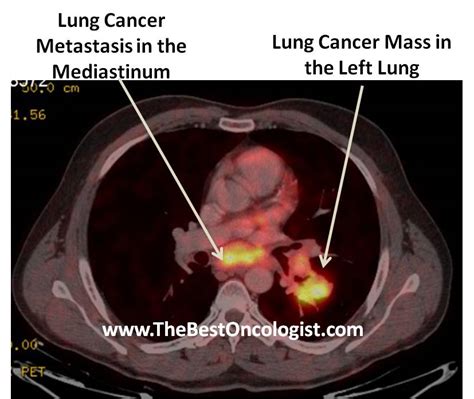 Treatment of Lung Cancer - The Best Oncologist TM