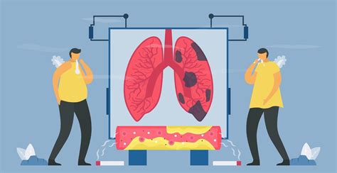 Chronic Obstructive Pulmonary Disease Or Copd 1212707 Vector Art At