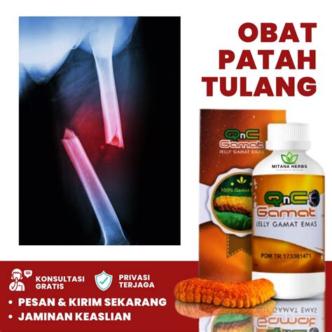 Jual Mitana Herbal Obat Patah Tulang Dan Retak Obat Herbal Patah