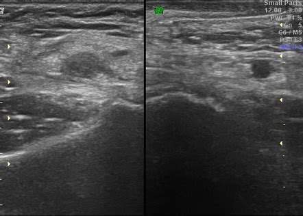 Vasitis | Radiology Case | Radiopaedia.org