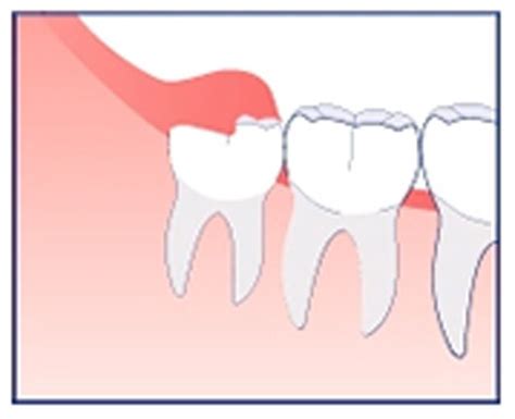 Akibat Membiarkan Gigi Impaksi News And Events Identistree Clinic