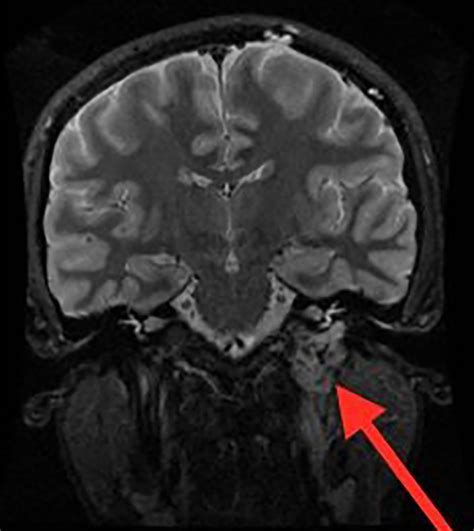 A Case Of Pulsatile Tinnitus The Bmj