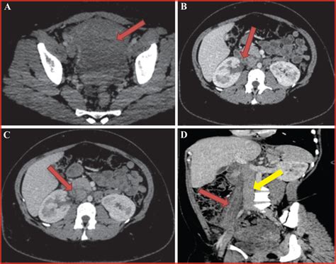 Jle Sang Thrombose Vaisseaux Une Pathologie Mimant Une Appendicite