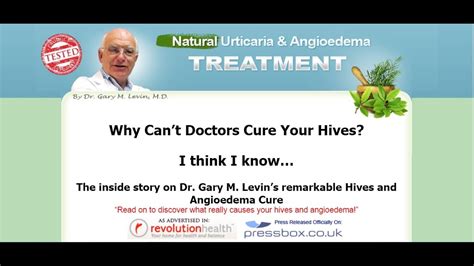 Natural Urticaria Treatment System Story On Dr Gary M Levins