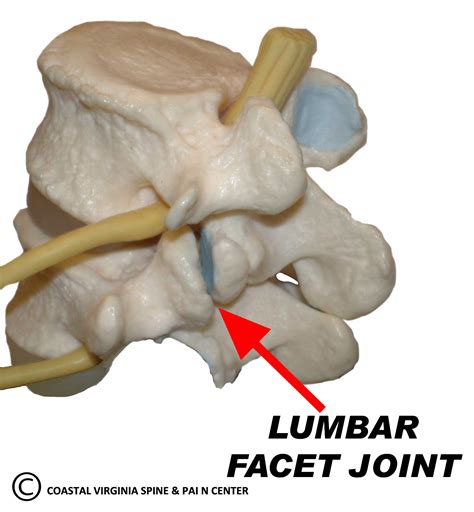 Lumbar Facet Joint Arthritis