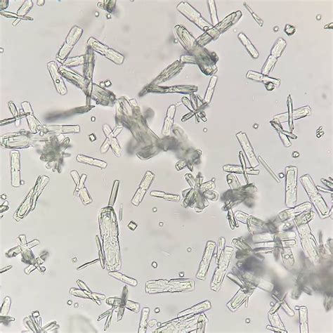 Tipos De Cristales En La Orina