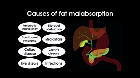 What's fat malabsorption l Symptoms, Causes, Treatment l - YouTube