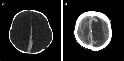 Case 4 A Ct Demonstrating Hydranencephaly B Ct Obtained At 5 Years Of