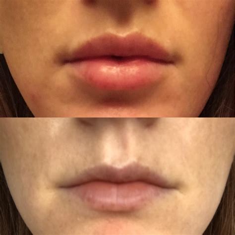 1 5ml Of Lip Filler Over ~6months R Plasticsurgery