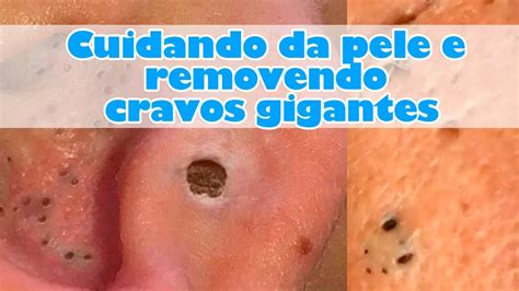 Cuidando Da Pele E Removendo Cravos Gigantes Cravos Pretos Giant