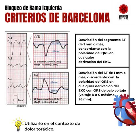 Criterios Barcelona Bloqueo De Rama Izquierda Urgencias Medicas