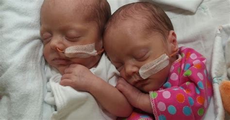 Monoamniotic Twins Rare Monoamniotic Twins Delivered At Packard Hospital