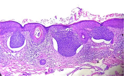 A Histopathology Picture Of A Nodular Bcc Showing Slightly Acanthotic