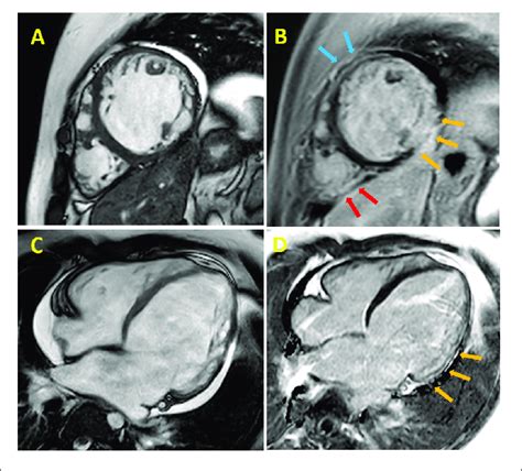 Cardiac Magnetic Resonance Cmr Cine Imaging Of A 24 Years Old Dmd