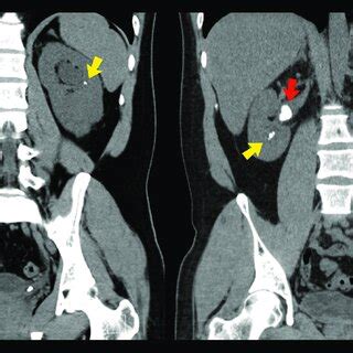 Preoperative Computed Tomography Scan Showing Bilateral Kidney Stones