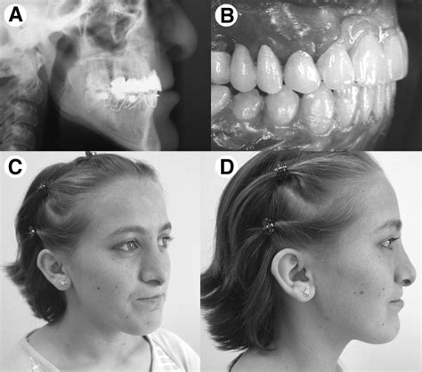 Maxillary Anterior Segmental Advancement Of Hypoplastic Maxilla In