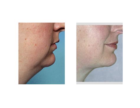 Options in Neck Reshaping and Contouring - Explore Plastic Surgery