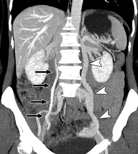 Gonadal Vein Anatomy