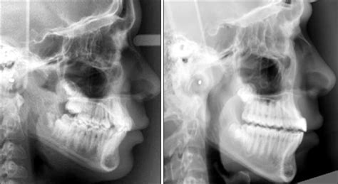 Pretreatment And Post Treatment Lateral Cephalometric Radiographs