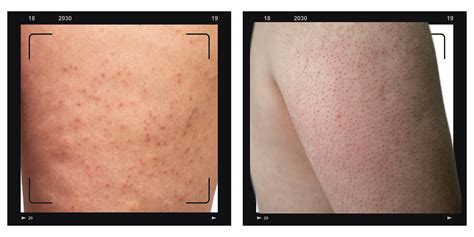 Keratosis Pilaris Kp Causes And Management Skin Federation