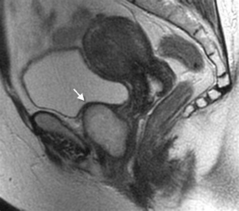 Duplicate Cysts In The Anterior Vaginal Wall Mri Findings Eurorad