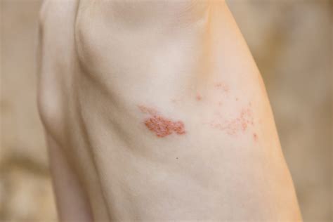 Kompatibel Mit Hinweis Jederzeit Herpes Zoster Im Ohr Symptome Leiter