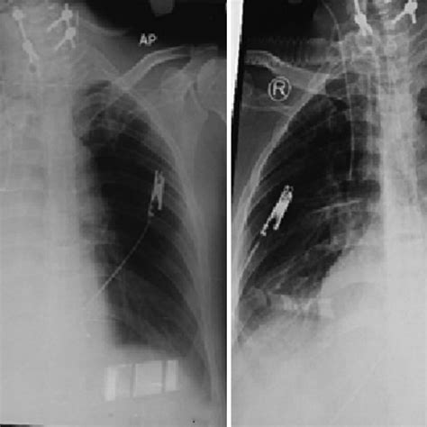 (a) Chest X-ray anteroposterior view showing right-sided complete lung... | Download Scientific ...