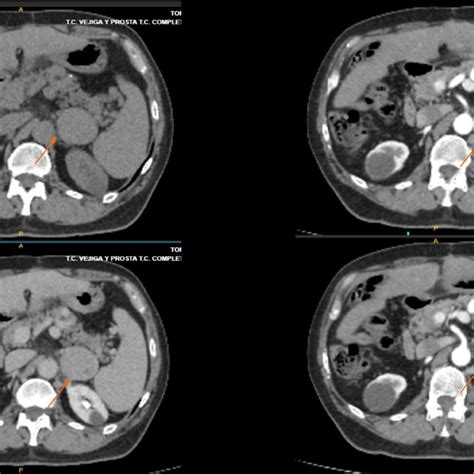 Metastatic Site Of Hepatocellular Recurrence After Liver Download Scientific Diagram