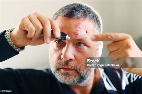 Man With Herpes Zoster On The Face Close Up Man Suffering From Herpes