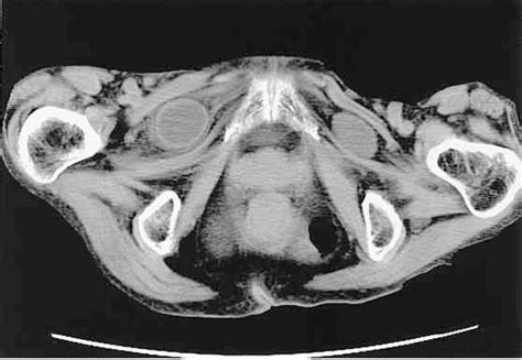 Obturator Hernia Semantic Scholar