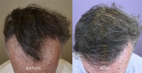 Video Comb Through Case Study Norwood Class Hair Restoration Of