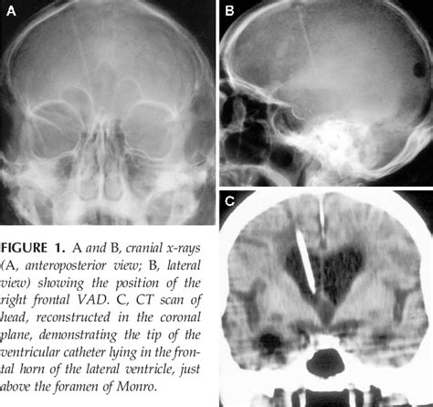 Figure 1 From Routine Placement Of A Ventricular Reservoir At Endoscopic Third Ventriculostomy