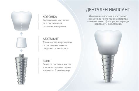 Имплантология Дентален център Недеви