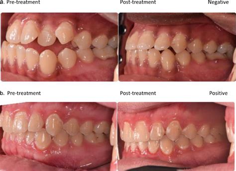 Prevalence Of White Spot Lesions And Risk Factors Associated With The