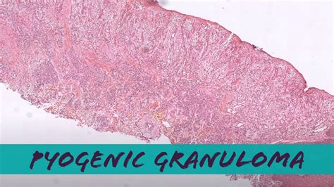 Peripheral Giant Cell Granuloma Histology